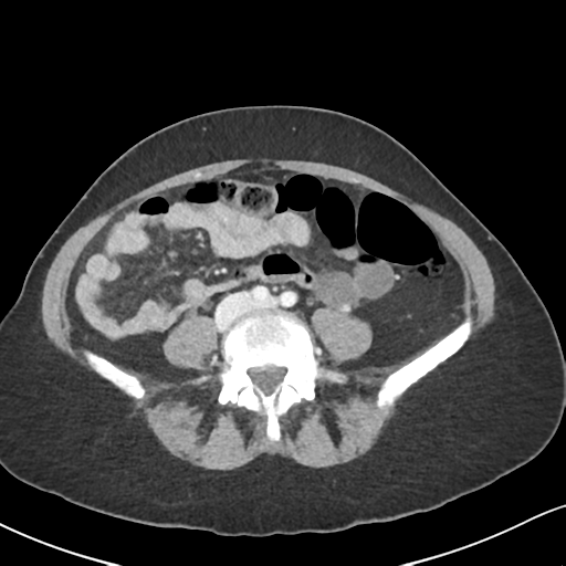 Cecal internal hernia through the foramen of Winslow (Radiopaedia 44820-48651 B 47).png