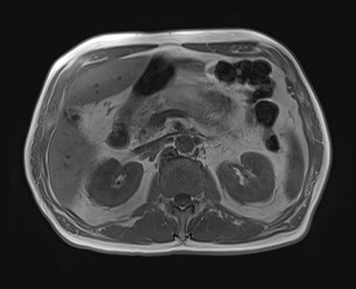 Cecal mass causing appendicitis (Radiopaedia 59207-66532 Axial T1 in-phase 51).jpg