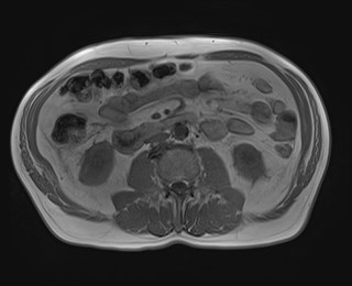 File:Cecal mass causing appendicitis (Radiopaedia 59207-66532 Axial T1 in-phase 71).jpg