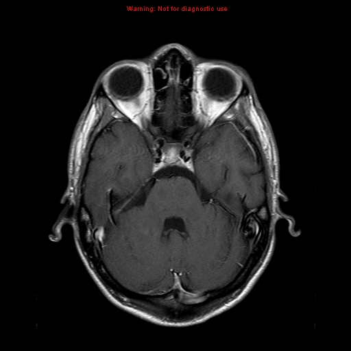 File:Central nervous system vasculitis (Radiopaedia 8410-9235 Axial T1 C+ 7).jpg