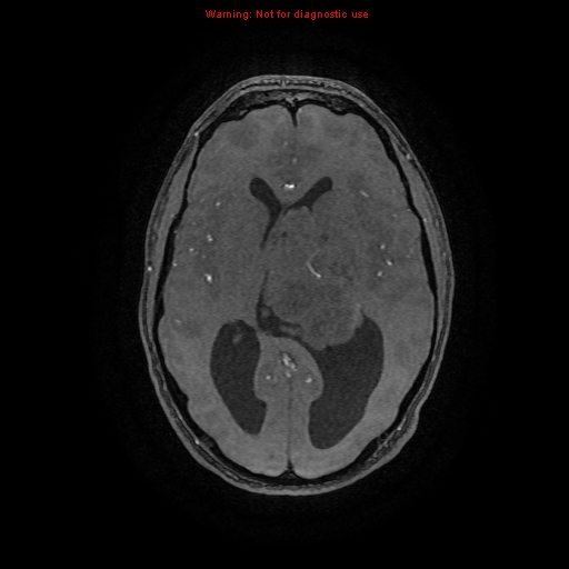 Central neurocytoma (Radiopaedia 13188-13206 Axial MRA 41).jpg
