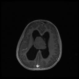 Central neurocytoma (Radiopaedia 30220-30842 Axial T1 C+ 97).jpg