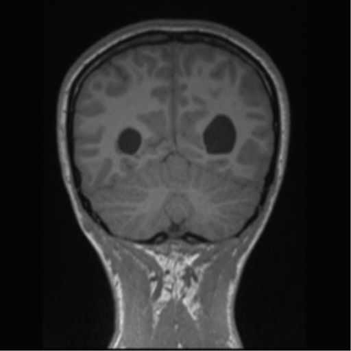 Central neurocytoma (Radiopaedia 37664-39557 Coronal T1 23).png
