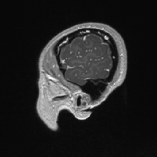 Central neurocytoma (Radiopaedia 37664-39557 Sagittal T1 C+ 13).png