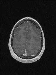 Central neurocytoma (Radiopaedia 56690-63469 Axial T1 C+ 138).jpg