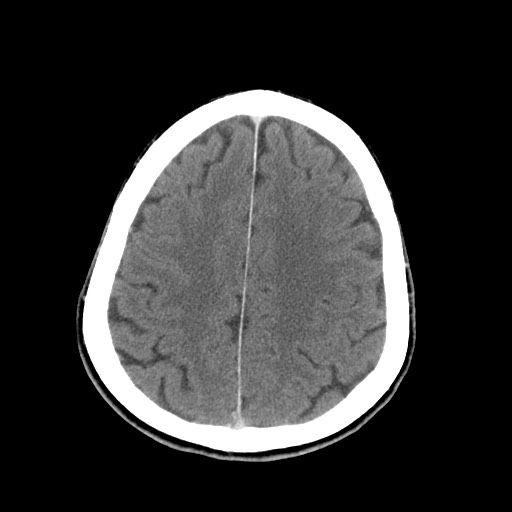 Central neurocytoma (Radiopaedia 68725-78432 Axial C+ 71).jpg