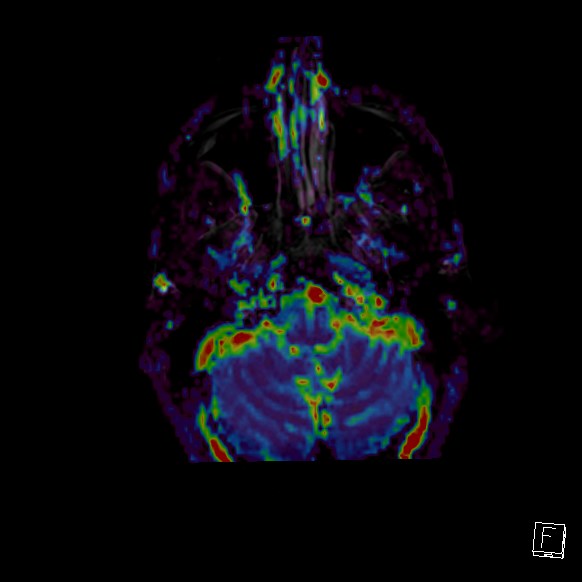 Central neurocytoma (Radiopaedia 84497-99872 Axial Perfusion 250).jpg