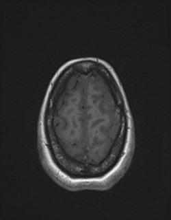 Central neurocytoma (Radiopaedia 84497-99872 Axial T1 166).jpg