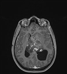 Central neurocytoma (Radiopaedia 84497-99872 Axial T1 C+ 86).jpg