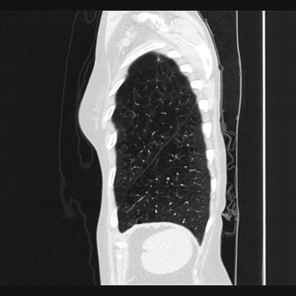 Centrilobular pulmonary emphysema (Radiopaedia 24495-24789 Sagittal lung window 76).jpg