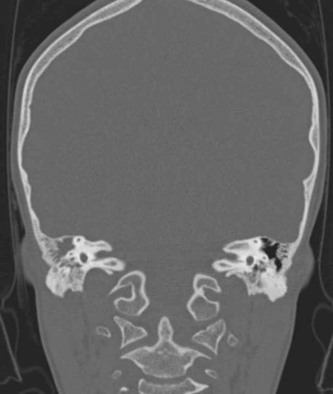 Cerebellar abscess (Radiopaedia 73727-84527 Coronal bone window 53).jpg
