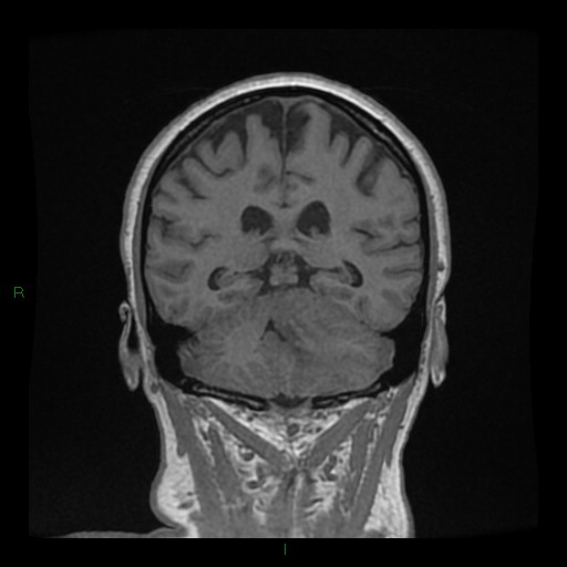 Cerebellar abscess (Radiopaedia 78135-90678 Coronal T1 C+ 105).jpg