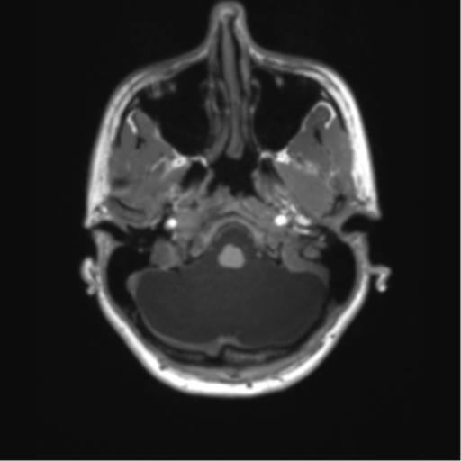 Cerebellar agenesis with hypoplastic pons (pontocerebellar hypoplasia) (Radiopaedia 57224-64138 Axial T1 16).png