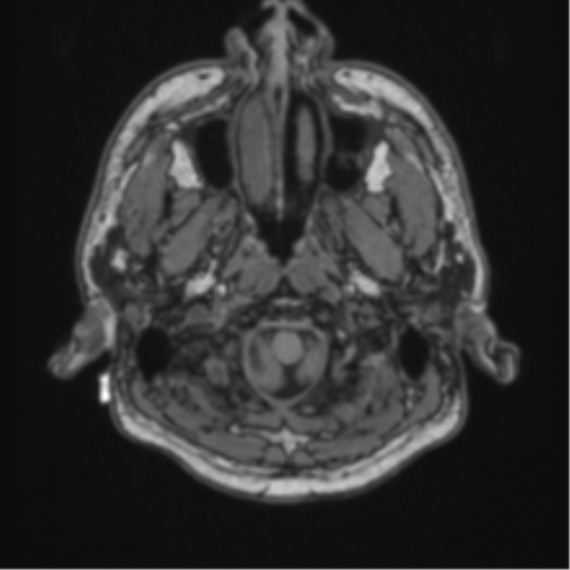 Cerebellar hemangioblastomas and pituitary adenoma (Radiopaedia 85490-101176 Axial T1 6).png