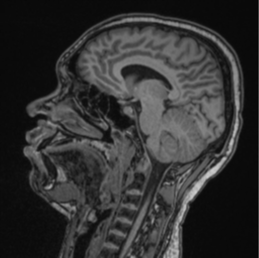 Cerebellar hemangioblastomas and pituitary adenoma (Radiopaedia 85490-101176 Sagittal T1 49).png