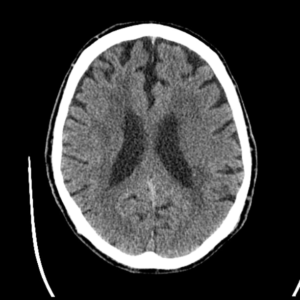 Cerebellar hemorrhage (Radiopaedia 27193-27359 Axial non-contrast 32).jpg