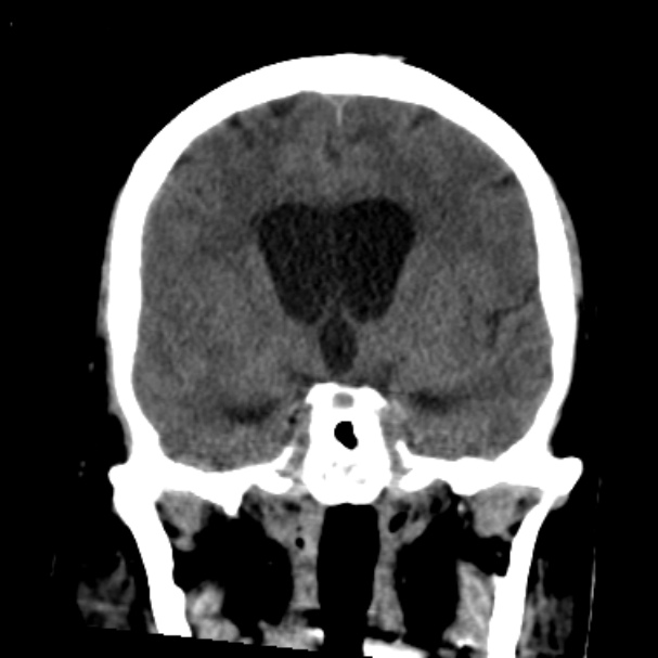 Cerebellar hemorrhage causing obstructive hydrocephalus (Radiopaedia 33989-35207 Coronal non-contrast 25).jpg