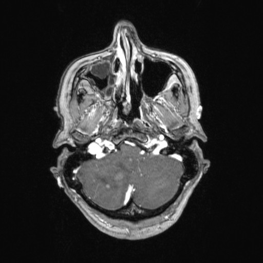 File:Cerebellar metastases (Radiopaedia 24038-24249 Axial T1 C+ 49).jpg