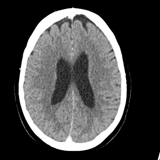 Cerebellar metastasis (Radiopaedia 54578-60812 Axial C+ 31).png