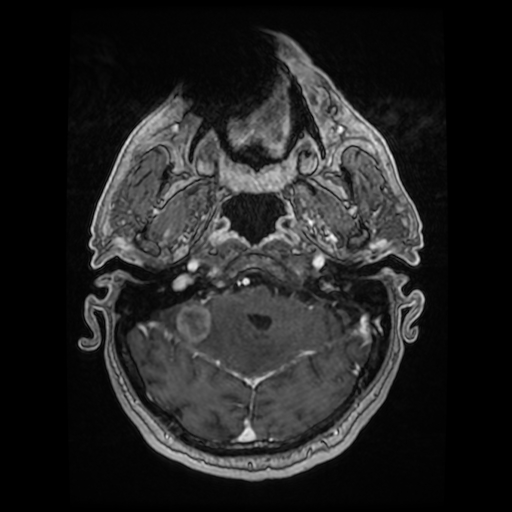 Cerebellar metastasis of pulmonary adenocarcinoma, cavernous venous malformation, and developmental venous anomaly (Radiopaedia 85827-101661 Axial T1 C+ 29).jpg