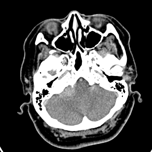 Cerebellopontine angle meningioma (Radiopaedia 35181-36714 A 37).jpg