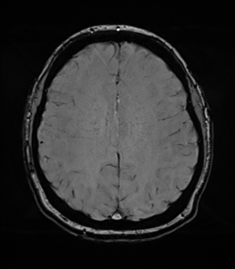 File:Cerebellopontine angle meningioma (Radiopaedia 48434-53348 Axial SWI 62).png