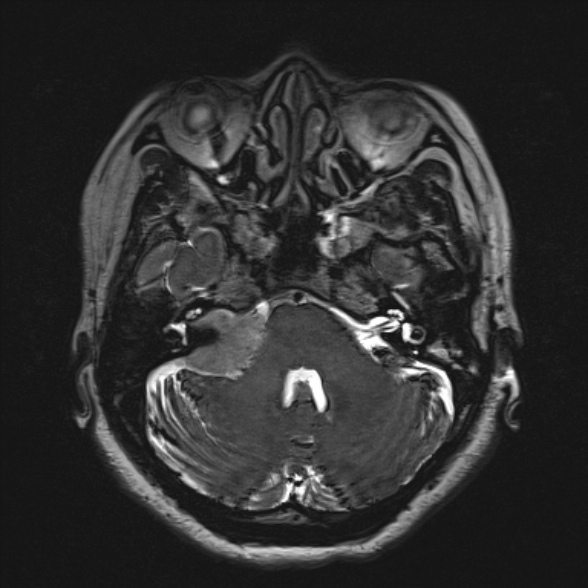 Cerebellopontine angle meningioma (Radiopaedia 53561-59591 Axial 3D volume T2 58).jpg