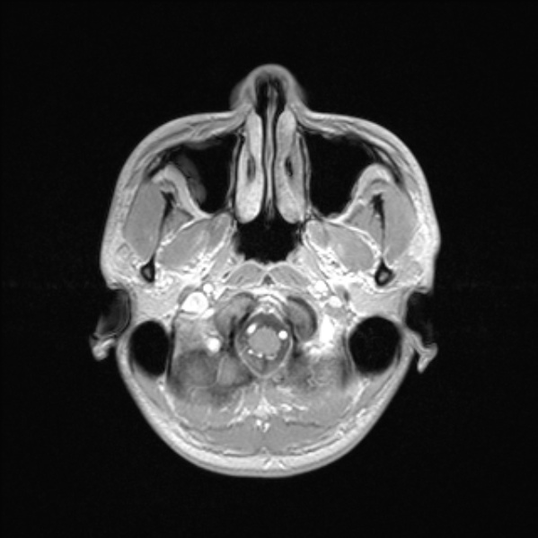 Cerebral abscess (Radiopaedia 24212-24478 Axial T1 C+ 11).jpg