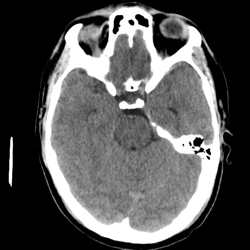 Cerebral abscess (Radiopaedia 29451-29919 Axial non-contrast 18).jpg