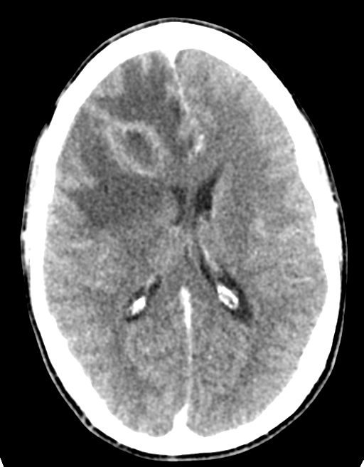 Cerebral abscess (Radiopaedia 60342-68008 Axial C+ delayed 30).png