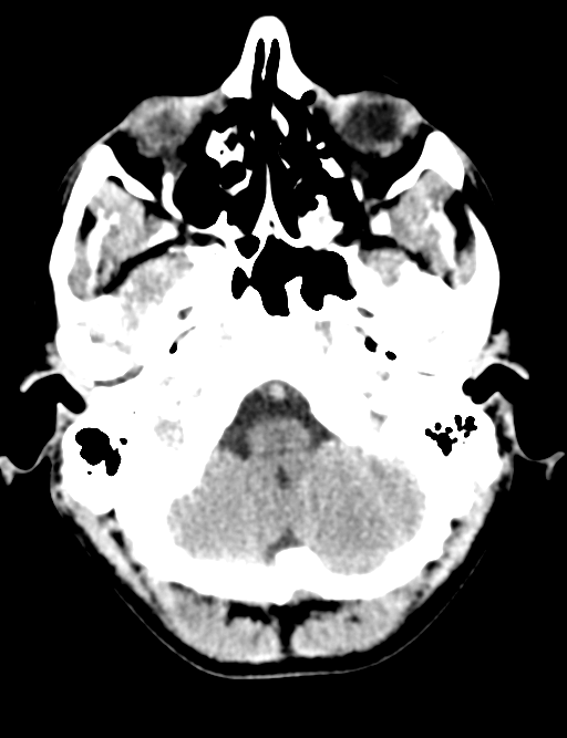 Cerebral abscess (Radiopaedia 60342-68008 Axial non-contrast 9).png