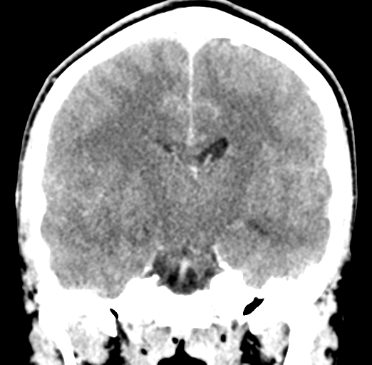 Cerebral abscess (Radiopaedia 60342-68008 Coronal C+ delayed 35).png