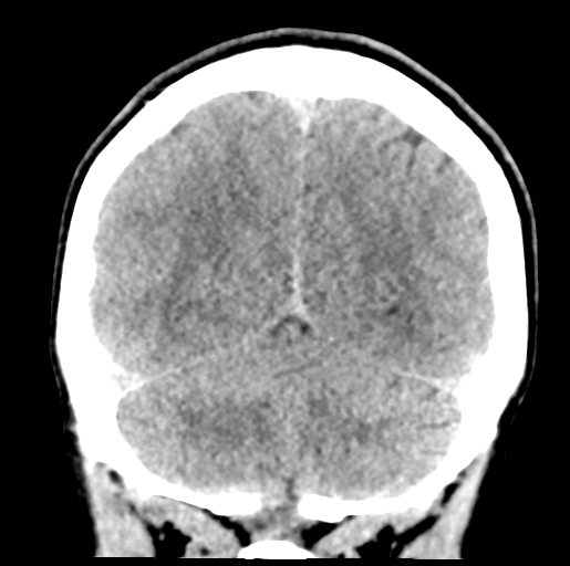 Cerebral abscess (Radiopaedia 60342-68008 Coronal non-contrast 49).png