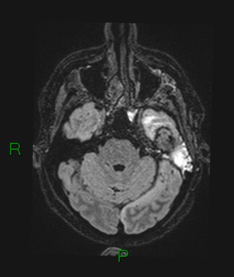Cerebral abscess and subdural empyema (Radiopaedia 84436-99779 Axial FLAIR 61).jpg