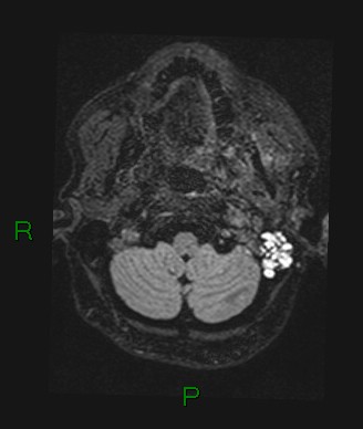 Cerebral abscess and subdural empyema (Radiopaedia 84436-99779 Axial FLAIR 75).jpg