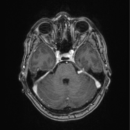 Cerebral abscess from pulmonary arteriovenous malformation (Radiopaedia 86275-102291 Axial T1 C+ 25).png