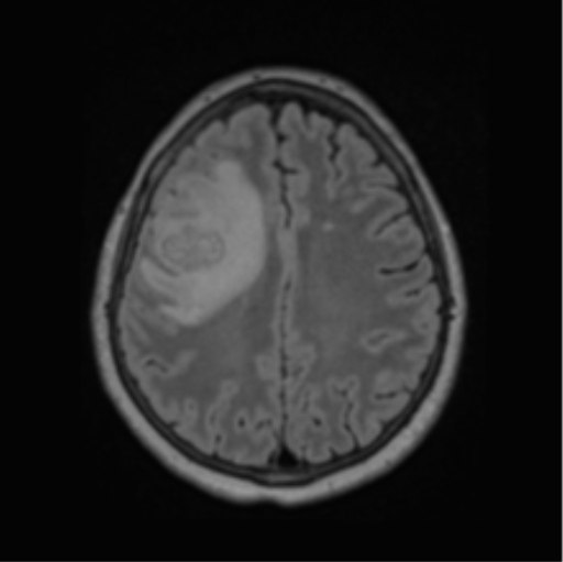 Cerebral abscess from pulmonary arteriovenous malformation (Radiopaedia 86275-102291 J 52).png