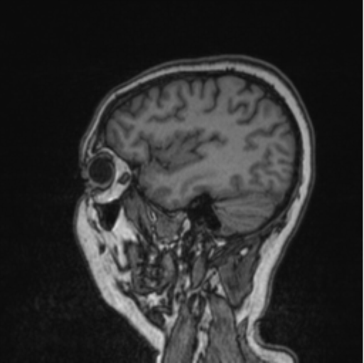 Cerebral abscess from pulmonary arteriovenous malformation (Radiopaedia 86275-102291 Sagittal T1 34).png