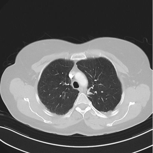 File:Cerebral abscess from pulmonary arteriovenous malformation (Radiopaedia 86275-102292 Axial lung window 19).png