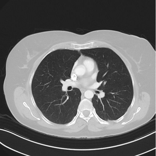 File:Cerebral abscess from pulmonary arteriovenous malformation (Radiopaedia 86275-102292 Axial lung window 29).png