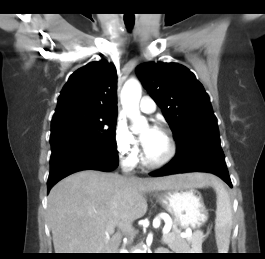 Cerebral abscess from pulmonary arteriovenous malformation (Radiopaedia 86275-102292 C 24).png
