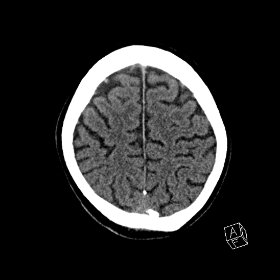 Cerebral abscess with ventriculitis (Radiopaedia 78965-91876 Axial non-contrast 39).jpg
