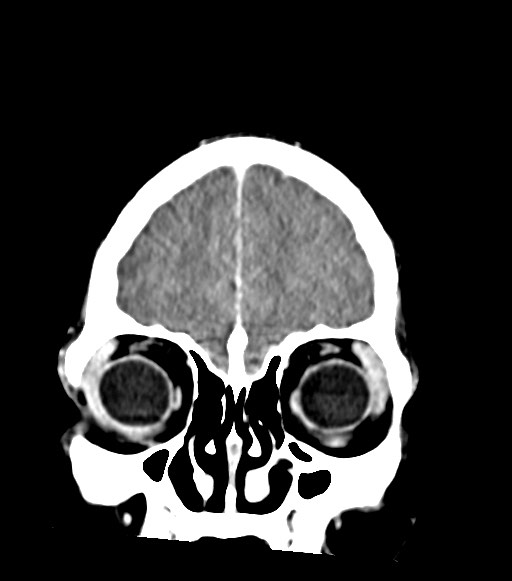 Cerebral abscesses (Radiopaedia 70458-80568 Coronal Contrast 13).jpg