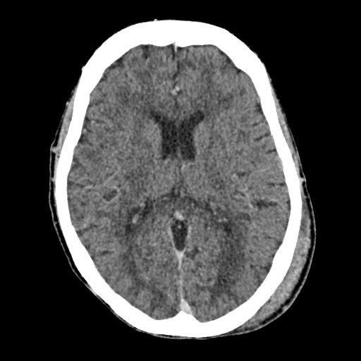 Cerebral amyloid angiopathy-related inflammation (Radiopaedia 74836-85848 Axial non-contrast 35).jpg