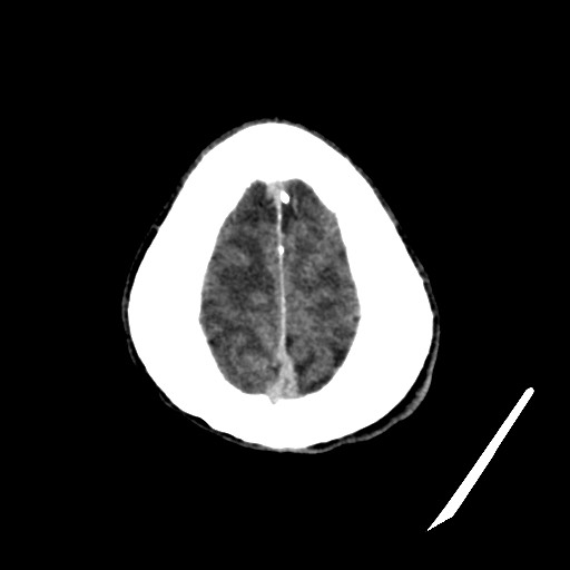 Cerebral amyloid angiopathy-related inflammation (Radiopaedia 74836-85848 Axial non-contrast 55).jpg