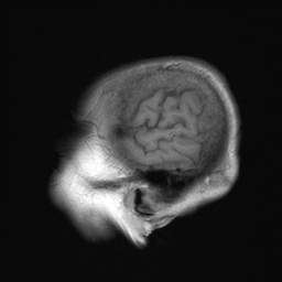 File:Cerebral amyloid angiopathy-related inflammation (Radiopaedia 74836-85849 Sagittal T1 30).jpg