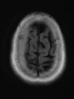 File:Cerebral amyloid angiopathy (Radiopaedia 29129-29518 Axial FLAIR 19).jpg