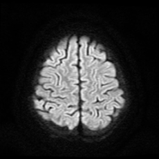 File:Cerebral and spinal tuberculosis (Radiopaedia 90489-107837 Axial DWI 18).jpg