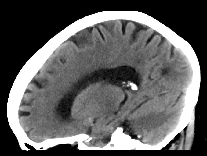 File:Cerebral aneurysm with rupture (Radiopaedia 29933-30457 B 12).jpg