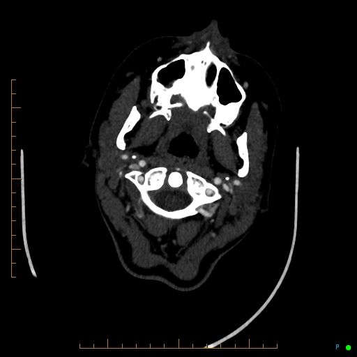 Cerebral arteriovenous malformation (AVM) (Radiopaedia 78162-90706 Axial CTA 28).jpg